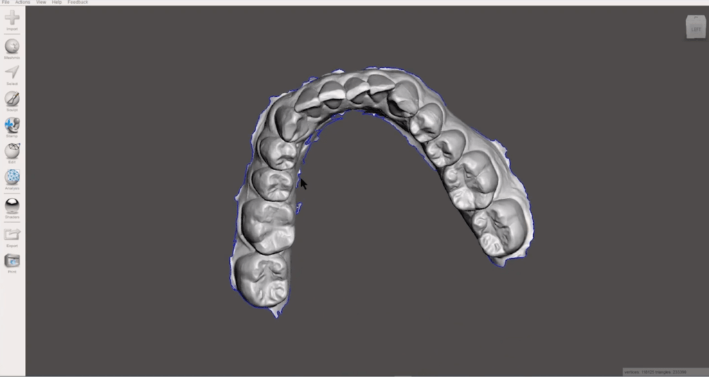 Modello dentale accurato con stampa 3D e modelli di allineatori con resina